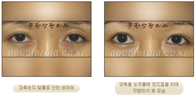 [Duhan Plastic Surgery Eye Surgery] - [Asymmetric Line, Eyelash Eversion, Deep Fixation] image 21