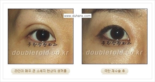 [두한성형외과 경쟁력 쌍꺼풀 재수술, 극한 재수술] - [망친 눈(쌍꺼풀) 복원수술과 일반 쌍꺼풀 재수술과의 차이점] 관련 이미지 9