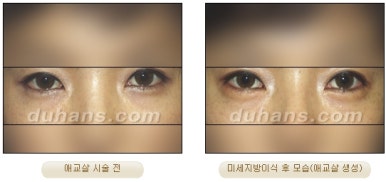 [두한성형외과 얼굴자가지방이식] - [눈밑 애교살 시술을 위한 미세지방이식] 관련 이미지 6