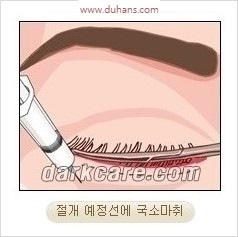 [두한성형외과 경쟁력 안검성형] - [젊어 보이면서 개선된 인상을 주기 위한 성형] 관련 이미지 3
