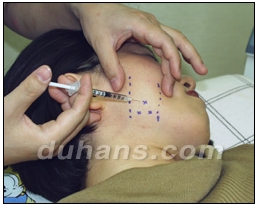 [Duhan Plastic Surgery Clinic Aesthetic Procedures] - [Square Jaw Botox] image 12