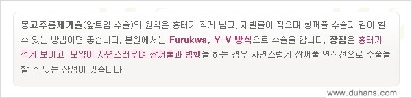 [두한성형외과 눈성형 FOCUS] - [몽고주름 제거(앞트임 제거) 수술 ②] 관련 이미지 9