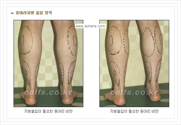 [두한성형외과 경쟁력 멀티종아리성형] - [종아리성형 방법별 전후 주의사항] 관련 이미지 20