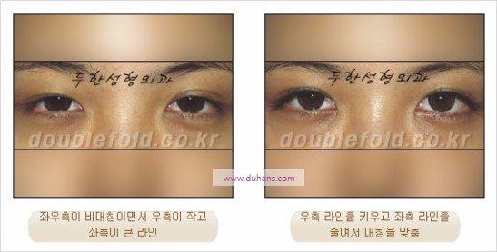 [두한성형외과 경쟁력 눈성형] - [비대칭 쌍꺼풀 라인의 여러 가지 교정 방법] 관련 이미지 12