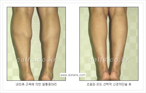 [두한성형외과의 경쟁력 멀티 종아리성형] - [근육퇴축을 위한 초음파 유도 선택적 신경차단술 안내] 관련 이미지 11