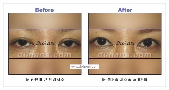 [두한성형외과 경쟁력 눈성형] - [안검하수(졸리운 눈매)의 종류와 교정 방법 안내] 관련 이미지 12