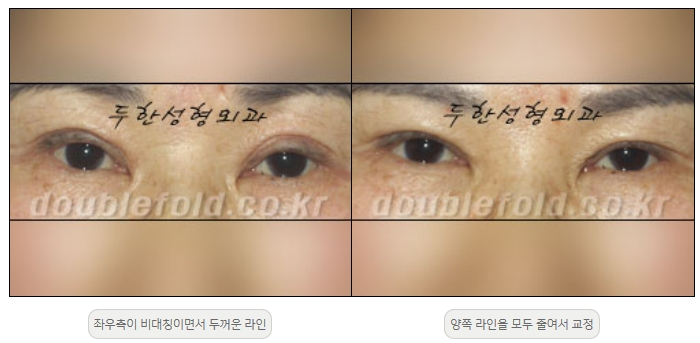 [두한성형외과 쌍커플재수술] - [비대칭 쌍커풀 라인] 관련 이미지 18