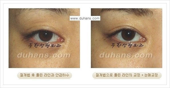 [두한성형외과 경쟁력 쌍꺼풀 재수술, 극한 재수술] - [풀려버린 쌍꺼풀 라인의 교정 방법 안내] 관련 이미지 3