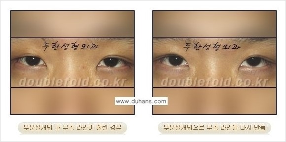[두한성형외과 경쟁력 쌍꺼풀 재수술] - [짝짝이 쌍꺼풀 라인 교정] 관련 이미지 9