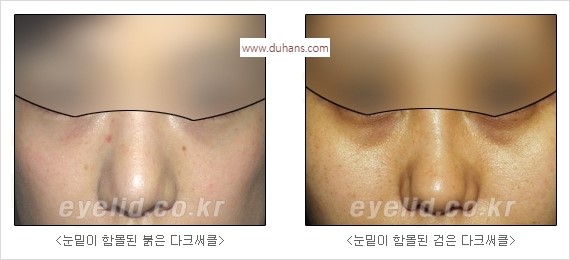 [두한성형외과 경쟁력 눈밑성형] - [눈밑 다크써클 수술 방법] 관련 이미지 3