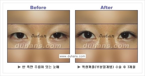 [두한성형외과 경쟁력 쌍꺼풀 재수술, 극한 재수술] - [퀵쌍꺼풀 안내] 관련 이미지 11