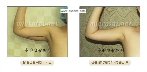 [두한성형외과 경쟁력 바디성형] - [하복부, 팔뚝, 허리선, 허벅지, 엉덩이 간편지방흡입술] 관련 이미지 11