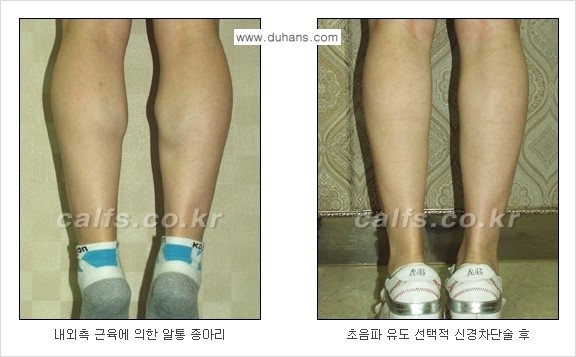 ​[두한성형외과와 날씬한 종아리 만들기!] - [간편하고 안전한 종아리 축소방법 ④] 관련 이미지 5