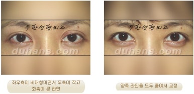 두한성형외과 눈재수술 - 쌍꺼풀 재수술 방법 관련 이미지 12