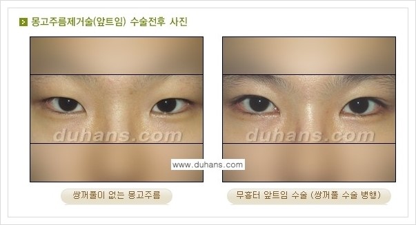 [두한성형외과 경쟁력 눈성형] - [흉터없는 몽고주름 제거 - 앞트임 수술 안내] 관련 이미지 3