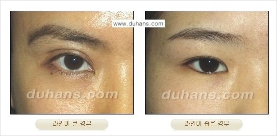 ​[두한성형외과 경쟁력 쌍꺼풀 재수술] - [아름다운 쌍꺼풀 선의 기준과 쌍꺼풀 재수술시 검사와 테스트 안내] 관련 이미지 7