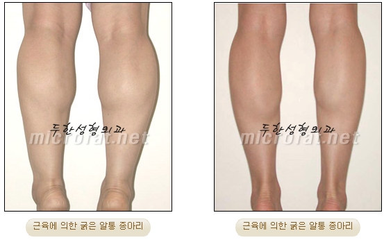 [Duhan Plastic Surgery Clinic Calf Contouring] - [Calf Reduction] image 3
