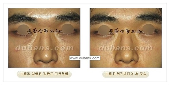 [두한성형외과 경쟁력 눈밑성형] - [꺼진 눈밑, 눈밑 함몰 주름선 눈밑 미세지방이식 안내] 관련 이미지 18