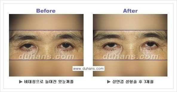 [두한성형외과 경쟁력 눈성형] - [상큼하고 환한 젊은 눈매 상안검성형(윗눈꺼풀 처짐) 안내] 관련 이미지 13