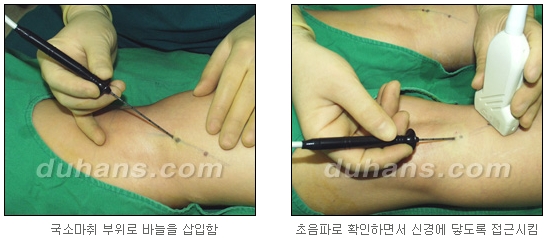 [두한성형외과 종아리 퇴축] - [종아리 퇴축술 재발 재수술] 관련 이미지 8