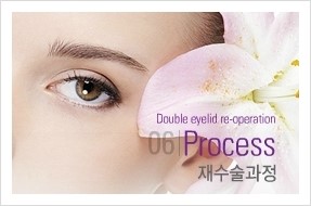 [두한성형외과 경쟁력 눈성형] - [쌍꺼풀 재수술, 눈재수술, 극한 눈재수술의 모든 것] 관련 이미지 6