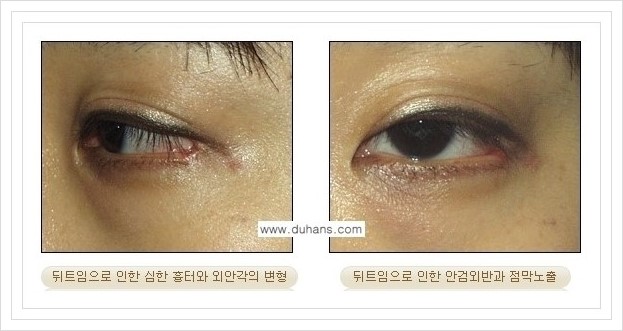 [두한성형외과 경쟁력 쌍꺼풀 재수술, 극한 눈재수술] - [뒤트임 부작용과 뒤트임 교정수술 방법 안내] 관련 이미지 5