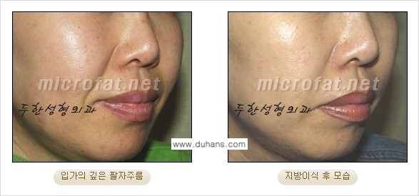 [두한성형외과 경쟁력 미세지방이식] - [입가주름, 팔자주름 미세지방이식 안내 ②] 관련 이미지 3