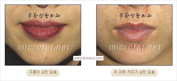 [두한성형외과 경쟁력 미세지방이식] - [입술 3차원 입체지방이식 안내 1.] 관련 이미지 3