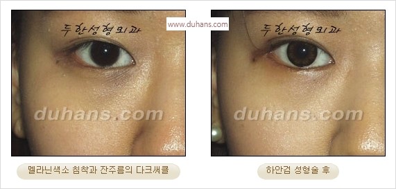 [두한성형외과 경쟁력 안검성형] - [눈밑주름 제거수술] 관련 이미지 19
