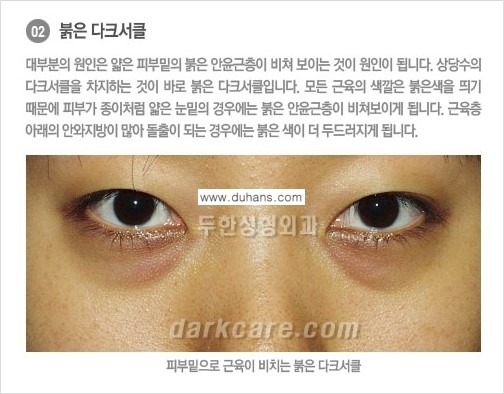 [두한성형외과 NO.1 경쟁력] - [원인과 색에 따른 다크써클의 종류] 관련 이미지 8