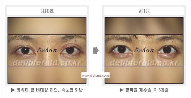 [두한성형외과 경쟁력 눈성형] - [나에게 맞는 어울리는 쌍꺼풀 라인] 관련 이미지 50
