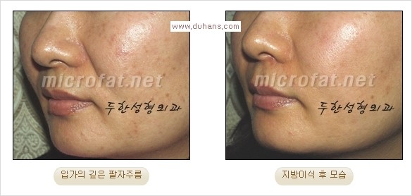 [두한성형외과 경쟁력 주름성형] - [입가주름과 코옆 팔자주름제거 지방이식 시술의 효과] 관련 이미지 16