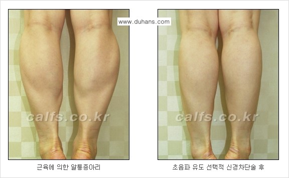 [두한성형외과] - [가을엔 아름답고 매끈한 다리 도전!​] 관련 이미지 3