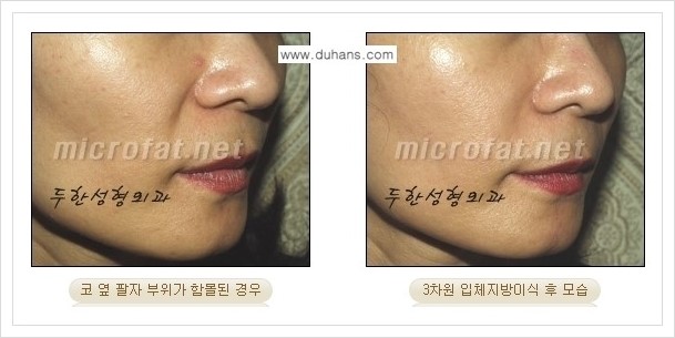 [두한성형외과 경쟁력 미세지방이식] - [귀족수술과 인디언밴드 교정 안내] 관련 이미지 14