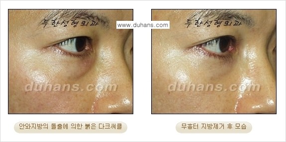 [두한성형외과 젊은 눈매 안검성형] - [눈밑 지방제거의 수술 전후 안내 ②] 관련 이미지 3