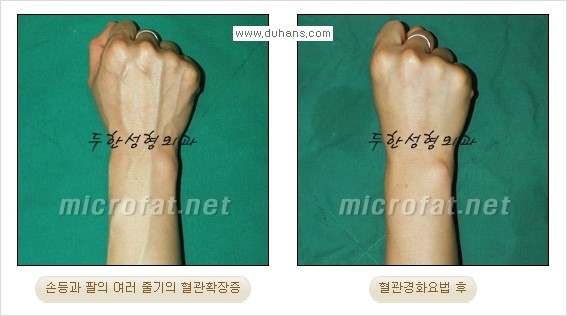 [두한성형외과 경쟁력 정맥류 치료] - [손, 손등, 손목혈관확장증, 팔혈관확장증에 질문과 답변] 관련 이미지 7