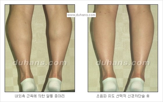 [두한성형외과 경쟁력 멀티종아리성형] - [종아리 퇴축수술 방법들의 문제점] 관련 이미지 14