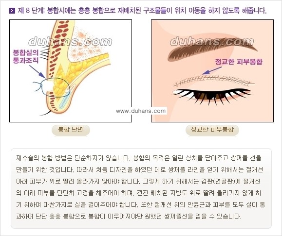 [두한성형외과 경쟁력 눈성형] - [쌍꺼풀 재수술 방법 - 완전절개법(Full incision method) 과정 안내] 관련 이미지 9