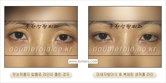 [두한성형외과 경쟁력 쌍꺼풀 재수술, 극한 눈재수술] - [미세지방이식으로 쌍꺼풀 라인의 복원에 관한 질문과 답변] 관련 이미지 3