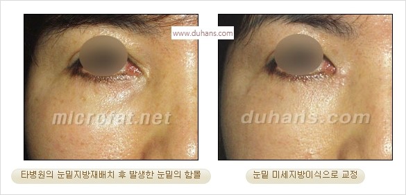 [두한성형외과 경쟁력 동안성형 리더] - ​[미간주름, 이마주름, 안검성형, 이마거상술, 눈썹거상술] 관련 이미지 66