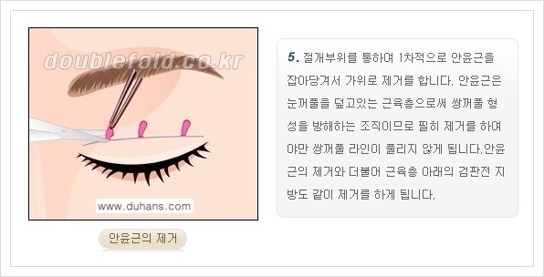 [두한성형외과 경쟁력 쌍꺼풀 재수술, 극한 재수술] - [쌍꺼풀 재수술의 과정 안내 1.] 관련 이미지 16