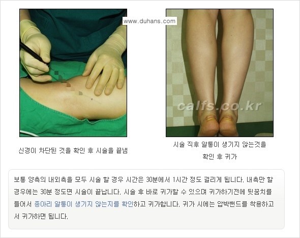 [두한성형외과 경쟁력 멀티종아리성형] - [종아리성형 방법별 전후 주의사항] 관련 이미지 12