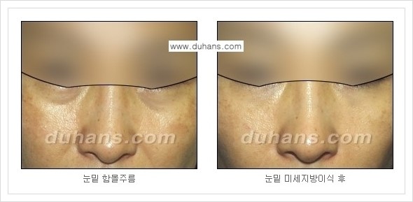 ​[두한성형외과 경쟁력 주름성형] - [주름교정을 위한 미세지방이식 안내 1.] 관련 이미지 17