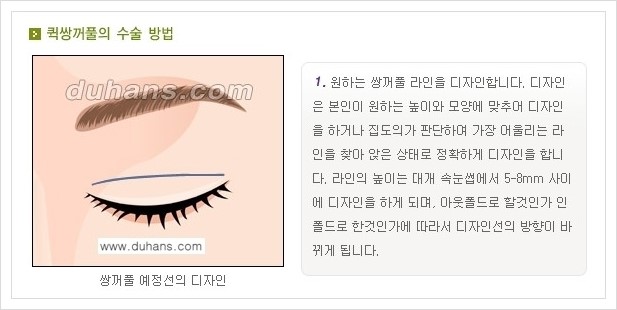 [두한성형외과 경쟁력 눈성형, 쌍꺼풀 수술] - [퀵쌍꺼풀(부분절개법)의 수술 안내] 관련 이미지 2