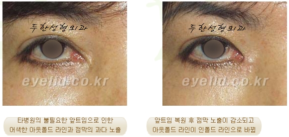 [두한성형외과 쌍꺼풀재수술] - [쌍꺼풀재수술성공요건, 쌍꺼풀재수술과정] 관련 이미지 11