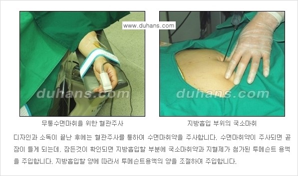 [두한성형외과 성형 FOCUS 간편 지방흡입] - [비만 탈출! 초음파 지방흡입 ②] 관련 이미지 4