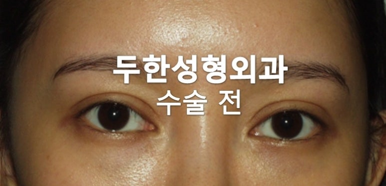 [Duhan Plastic Surgery Double Eyelid Revision Surgery] - [Lowering the Double Eyelid Line, Reducing the Double Eyelid Line, Sausage Eye Revision Surgery, Under-Eye Fat Grafting, Aegyo-sal] image 1