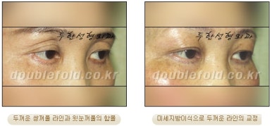 [DoubleFold Plastic Surgery Eye Surgery] - [Revision Surgery for Thick Double Eyelids] image 23