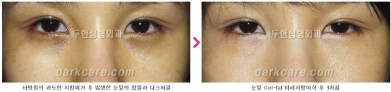 [두한성형외과 다크서클] - [다크서클 전후사진 검증] 관련 이미지 40