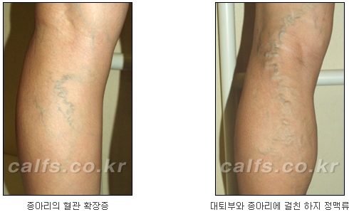 ​[두한성형외과 종아리성형] - [나에게 맞는 종아리시술] 관련 이미지 25